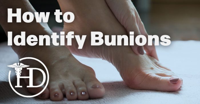Early signs of bunions