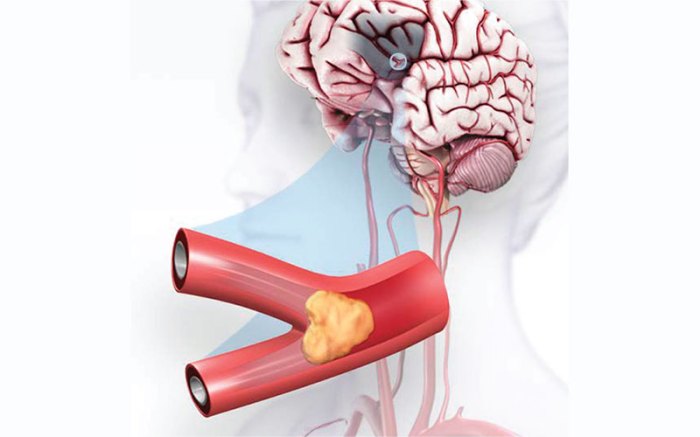 Ischemic Stroke (Clots) | American Stroke Association What is a thrombotic stroke