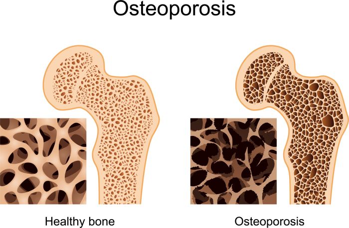 Osteoporosis fractures treatment and prevention