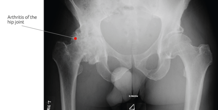 Stages of osteoarthritis of the hip