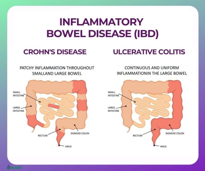 What is indeterminate colitis