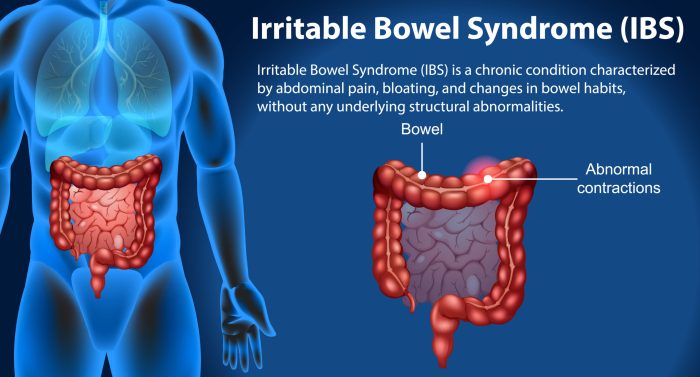 Irritable Bowel Symptoms What Is IBS, Or Irritable Bowel Syndrome? Ibs pain or trapped gas
