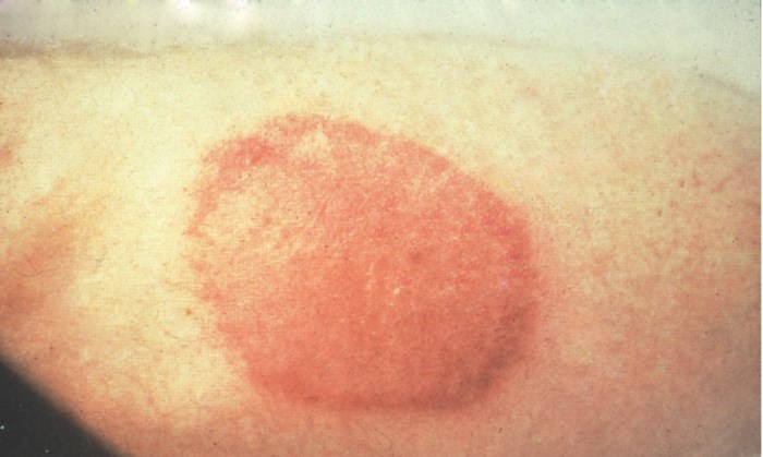 Lyme disease rash pictures
