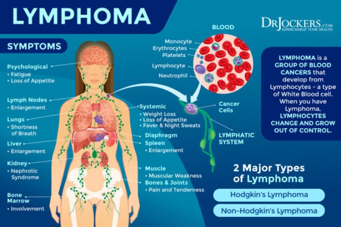 How is lymphoma treated