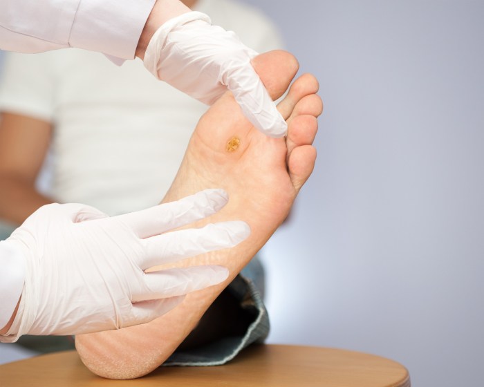 Photos of plantar warts on feet
