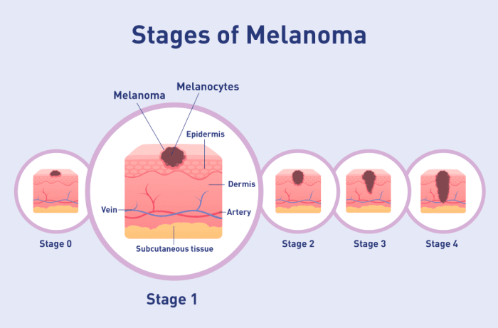 Melanoma stages poster stock vector. Illustration of cancer - 274843445 Melanoma staging what it means and reveals
