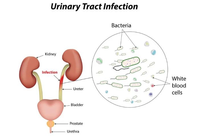 Signs your uti is going away