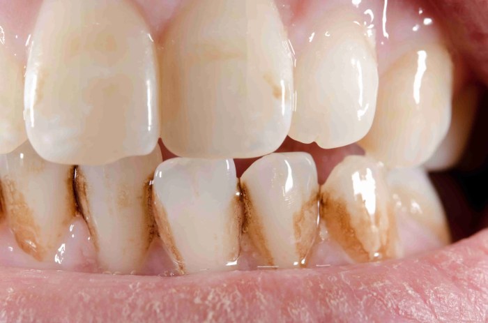 Brown spots on teeth