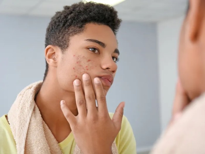 Tips for Dealing with Teenage Acne Treating teen acne in boys