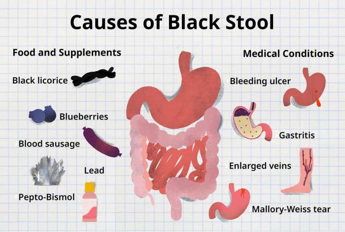 Causes of Black Stool A Deep Dive