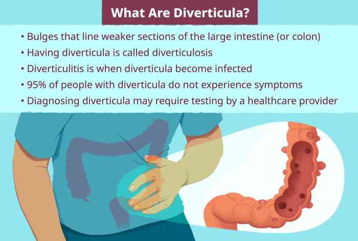 Diverticulitis vs ulcerative colitis