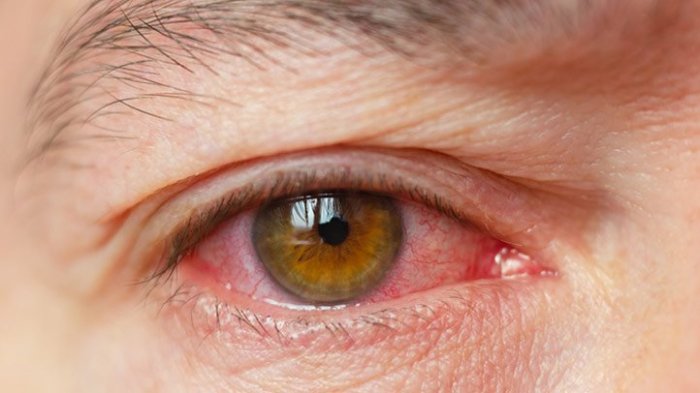 What Causes Dry Eyes All of a Sudden?  Understanding the Causes