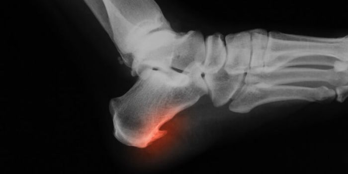 What are osteophytes bone spurs