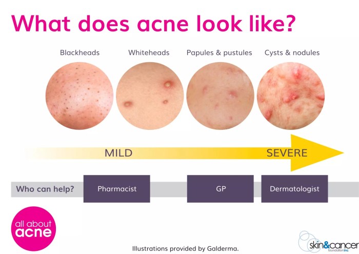 How to get rid of acne scars