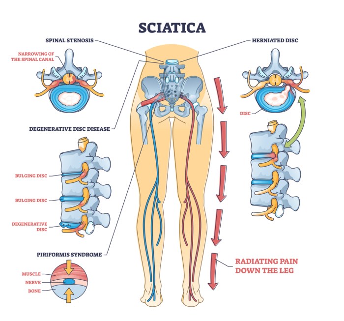 What causes sciatica buttock pain