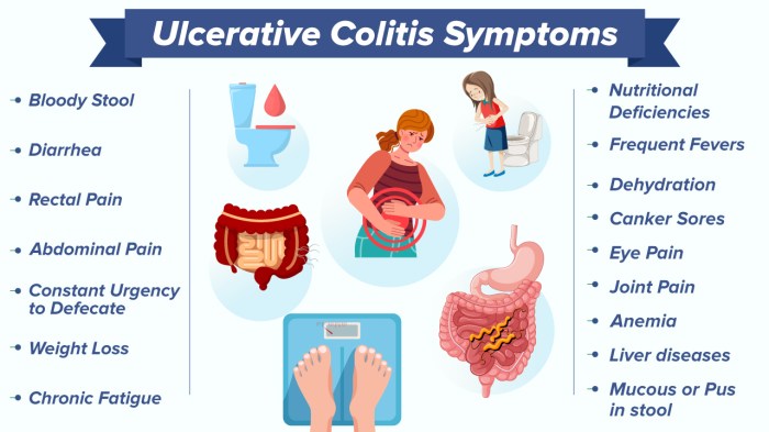 Ulcerative Colitis (UC): Symptoms, Causes, Diagnosis, Treatment ... Ulcerative colitis causes and risk factors