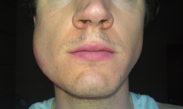 Is It a Lump or a Lymph Node? A Guide