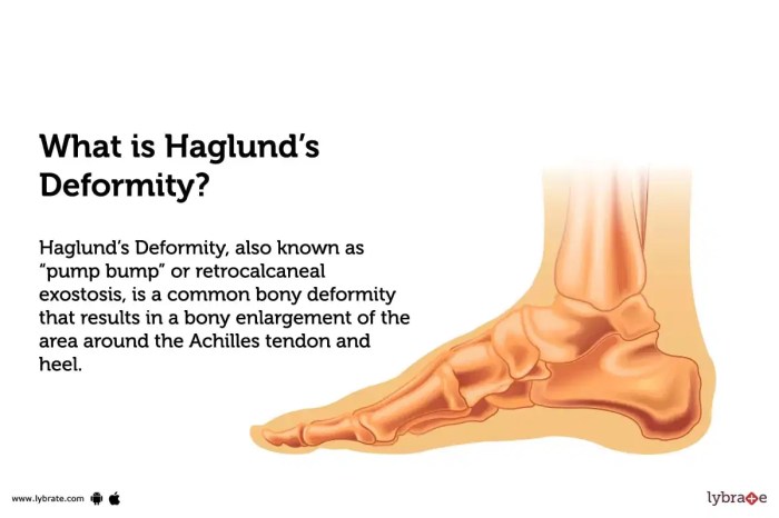 Haglunds Deformity Pump Bump A Comprehensive Guide