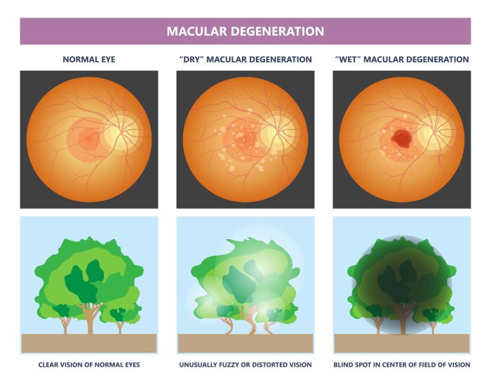Stages of Macular Degeneration A Deep Dive