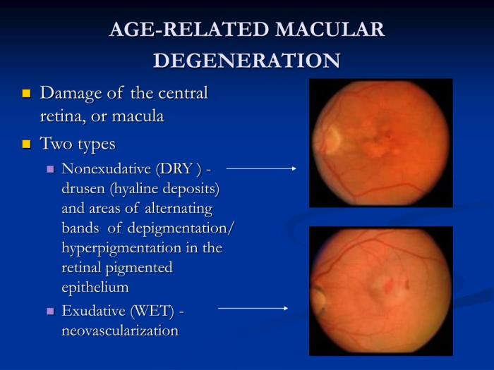 Stages of macular degeneration
