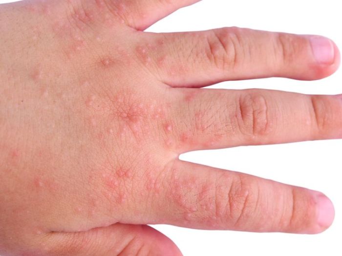 Blisters - Symptoms, Causes, Treatments Metastatic castration resistant prostate cancer symptoms