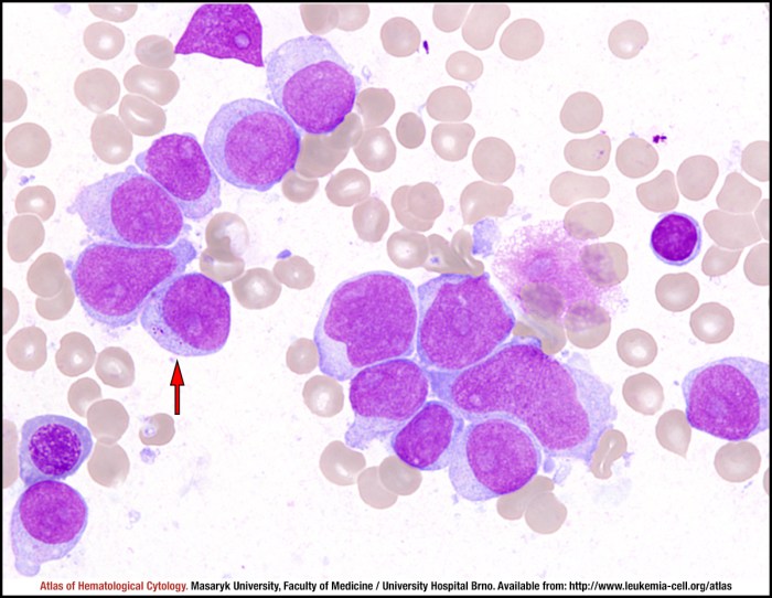 Chronic Myeloid Leukemia In Accelerated Phase With Thrombocytosis ... Chronic myelomonocytic leukemia cmml