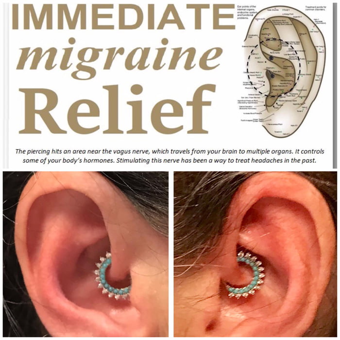 Daith piercing for migraine