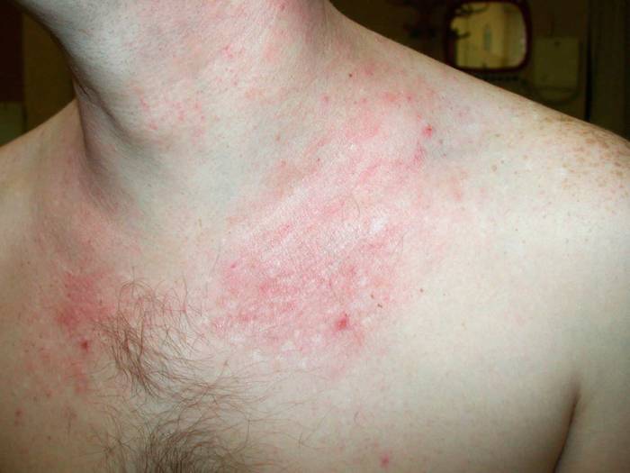 Is Eczema an Autoimmune Disease? Exploring the Connection