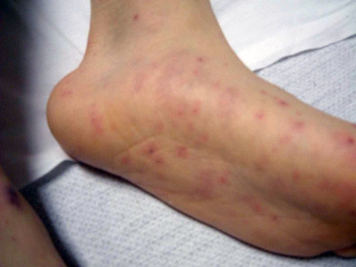 An Outbreak of Meningococcal Disease in Florida Is Growing, the C.D.C ... Menactra vaccine for meningococcal disease