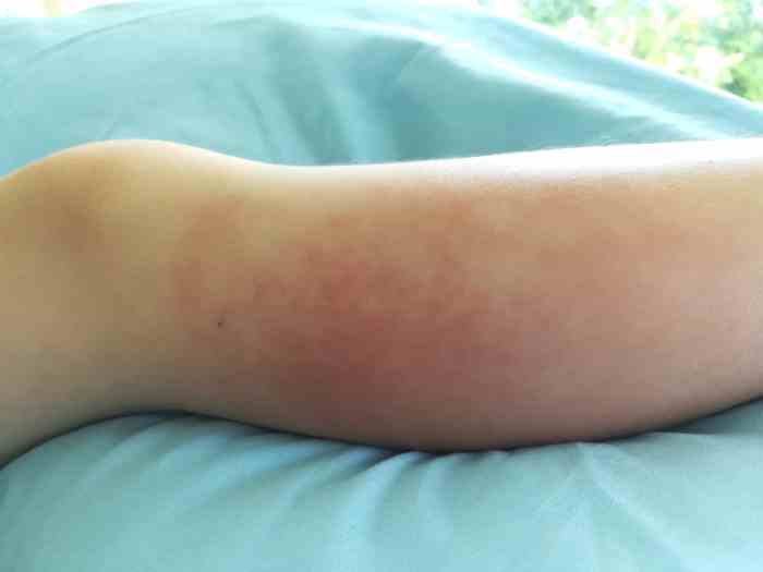 Cellulitis healing stages and timeline