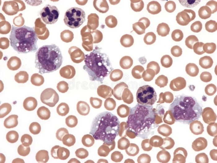Chronic Myelomonocytic Leukemia. Stock Photo - Image of dysplasia ... Chronic myelomonocytic leukemia cmml