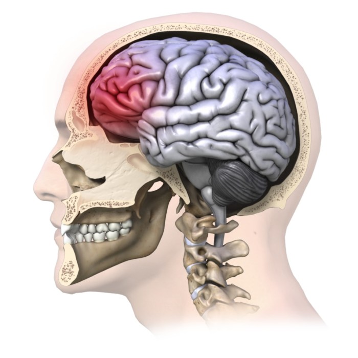 Difference between concussions and traumatic brain injuries