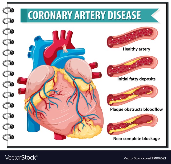 Coronary artery calcium scans