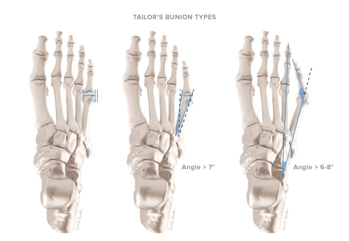 Bunions / Bunionettes » Identify Your Foot Pain What is a bunionette or tailors bunion on the foot