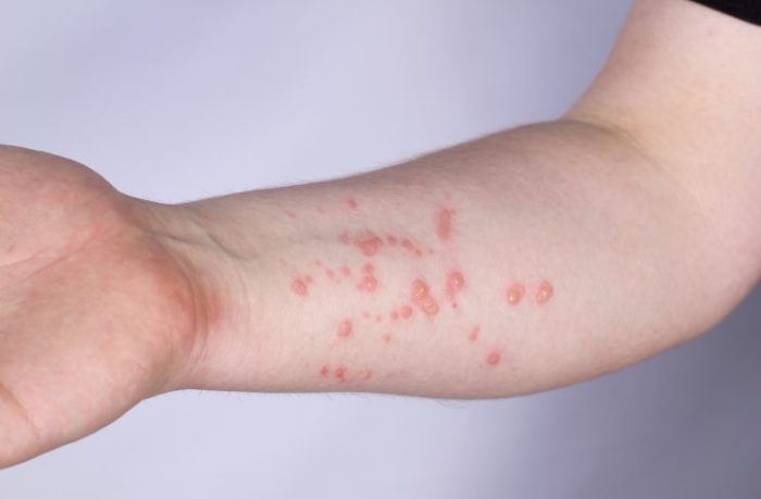 Red Spots On Skin: Here Are Its Common Causes And How To Get Rid Of Them | OnlyMyHealth Metastatic castration resistant prostate cancer symptoms