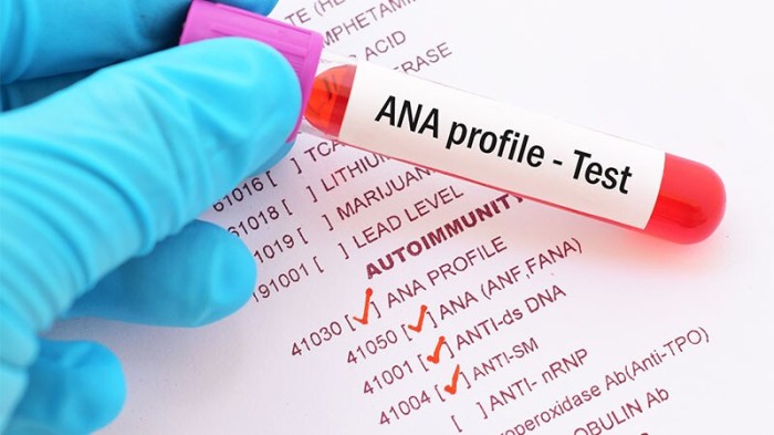 Ana Lab Test Diagnosis Code at Amanda Colton blog What is an ana test antinuclear antibody test