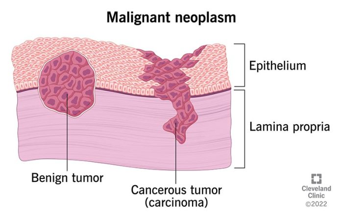 Malignant definition and characteristics