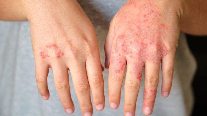 Symptoms of anemia in pregnancy