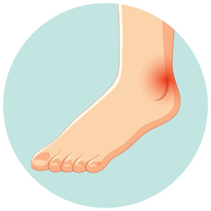 Bump on bottom of foot
