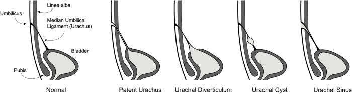 Urachus Meaning What is an urachal remnant