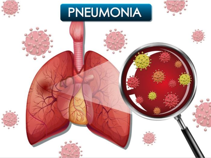 Pneumonia vs lung cancer