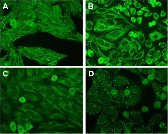Antinuclear antibodies: When to test and how to interpret findings ... What is an ana test antinuclear antibody test