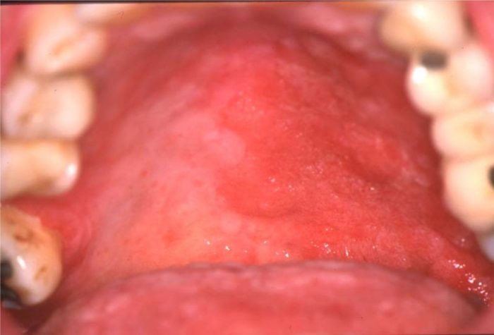 Graft versus host disease | PPT Coping with graft versus host disease