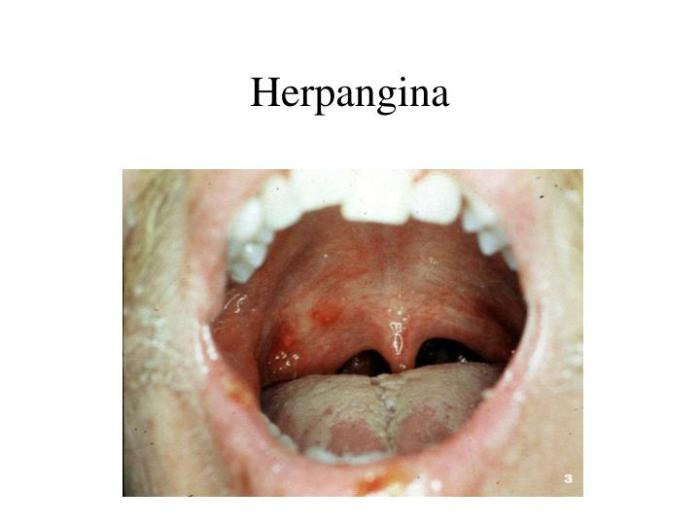 Herpangina viral infection of the mouth and throat