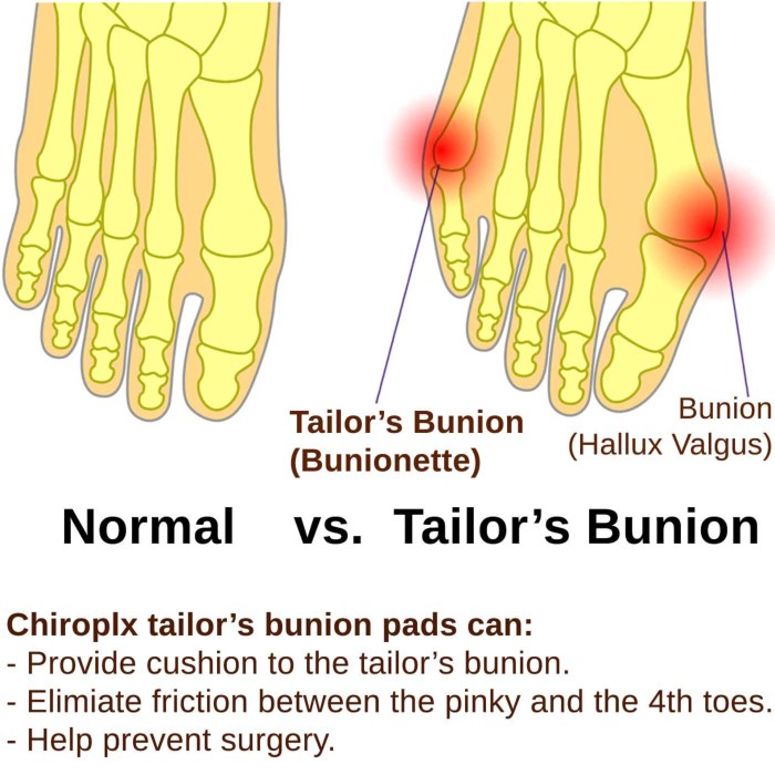 What is a bunionette or tailors bunion on the foot