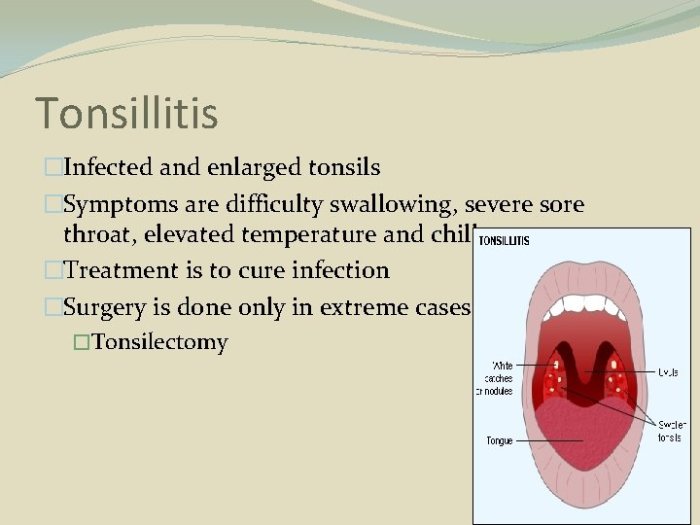 Dr Naval Kumar – Tonsillitis, Causes, Symptoms, Effects and Best ... Tonsillitis snoring and sleep apnea