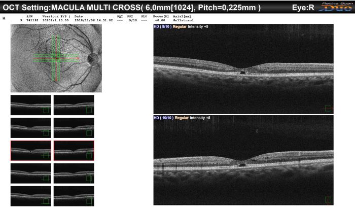 Macular telangiectasia eye disease