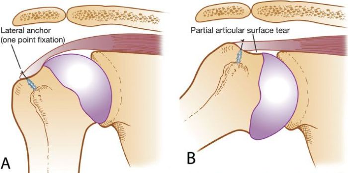 What is a partial tear of the rotator cuff