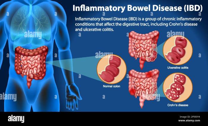 What is indeterminate colitis