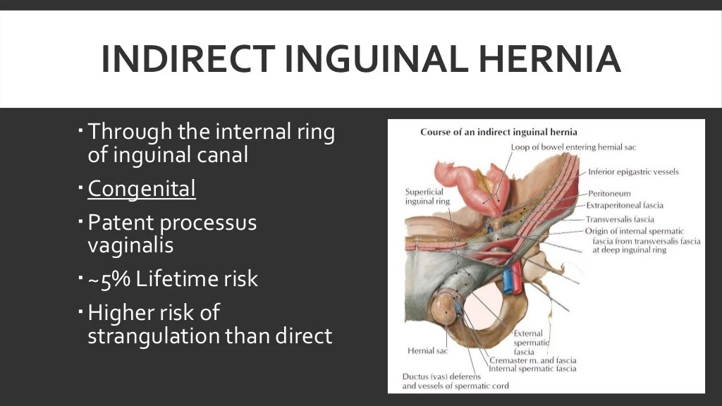 Direct Hernia – Surgical Notes Direct vs indirect hernia